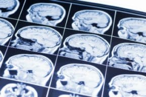 Traumatic Brain Injury May Heighten Risk of Dementia Later in Life