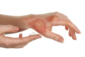 Our New York burn injury lawyers lists the common causes of burn injuries.