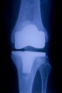 DePuy Knee Replacement