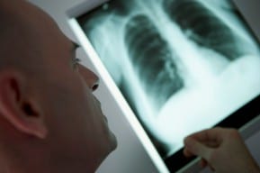 A New Jersey Mesothelioma lawyer review xrays while preparing a claim.