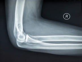 The New Jersey personal injury lawyers give good advice to victims of bone fractures and amputations.