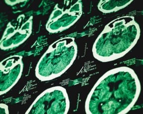 x-ray scans of a traumatic brain injury