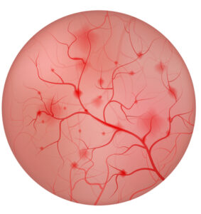 interstitial cystitis 