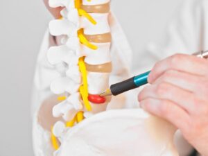 Doctor showing a herniated disc injury