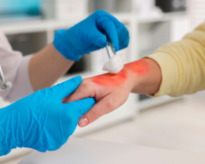 a doctor treating a man's burned hand
